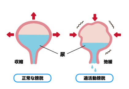 女性に多い頻尿の主な原因